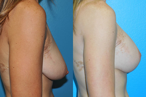 Augmentation