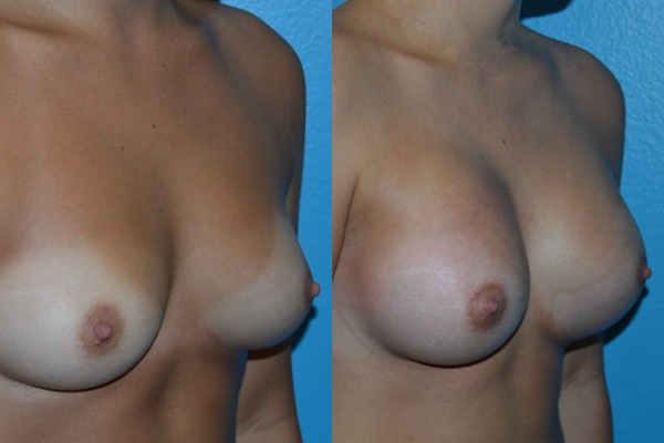 Augmentation