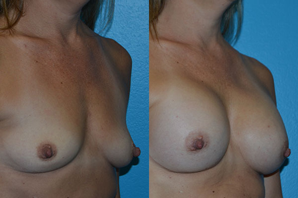Augmentation