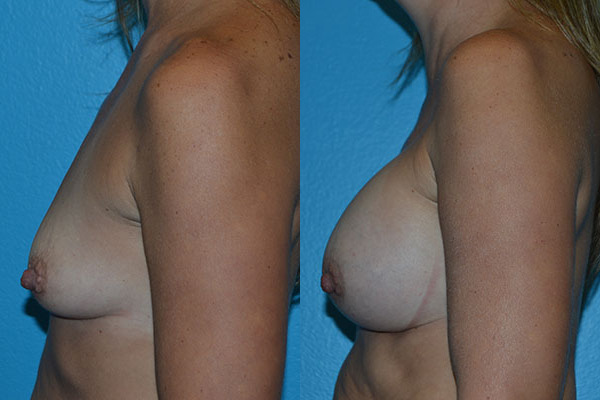 Augmentation