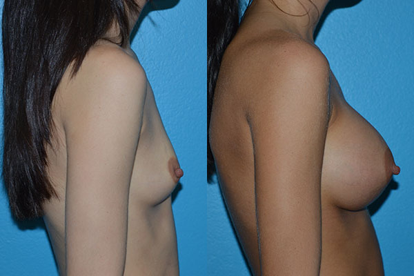 Augmentation