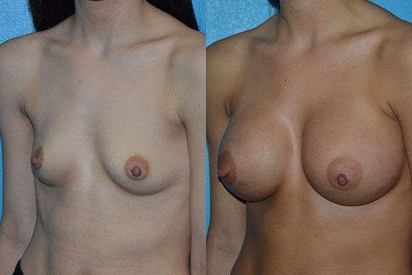 Augmentation