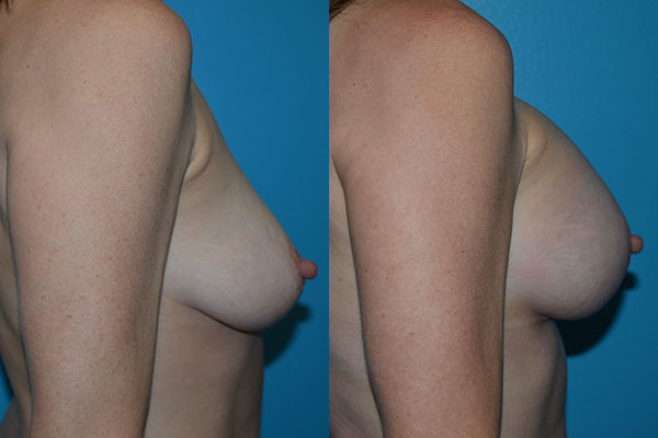 Augmentation