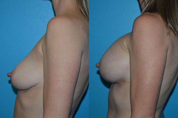 Augmentation