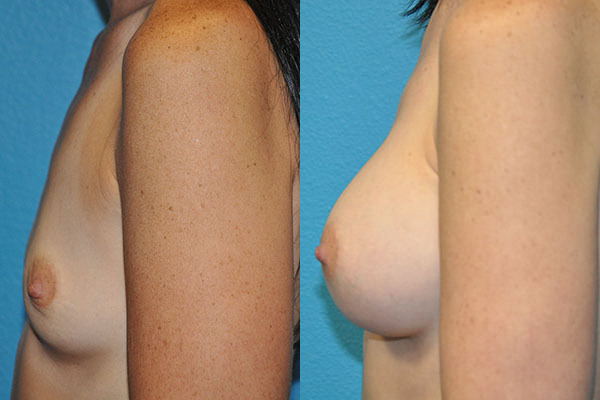 Augmentation