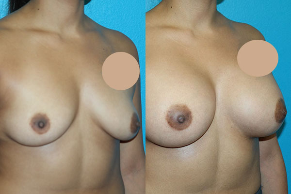 Augmentation