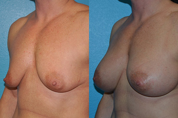 Augmentation
