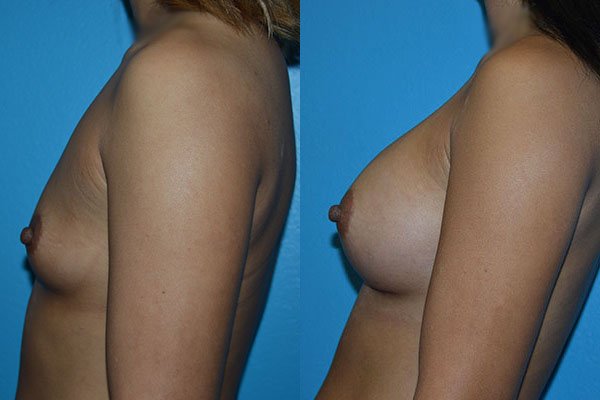 Augmentation