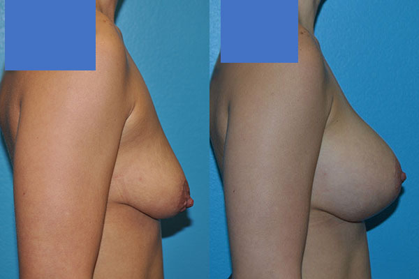 Augmentation