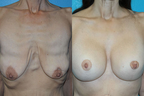 Augmentation