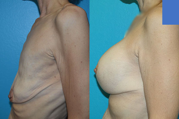 Augmentation