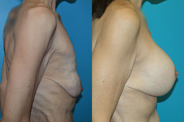 Augmentation