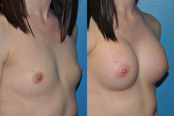 Augmentation