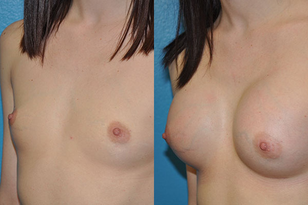 Augmentation