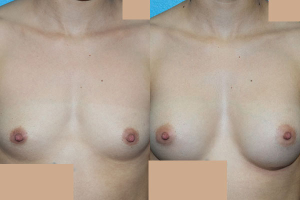 Augmentation