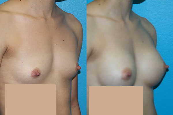 Augmentation
