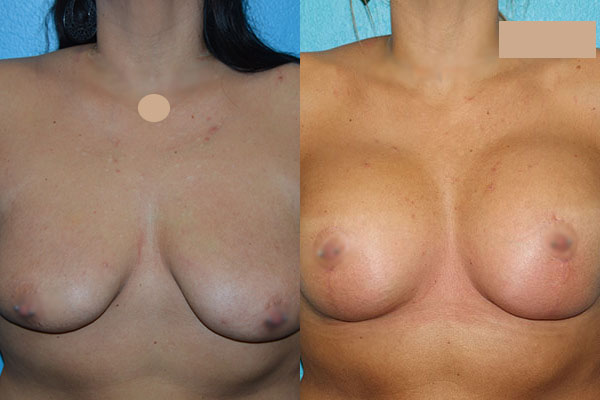 Augmentation