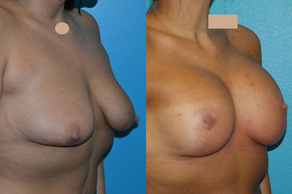 Augmentation