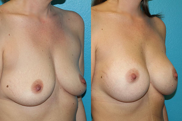 Augmentation