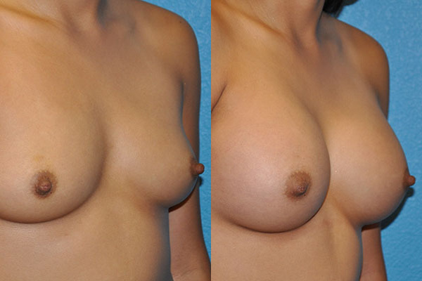 Augmentation