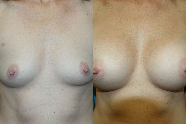 Augmentation