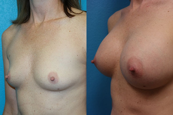 Augmentation