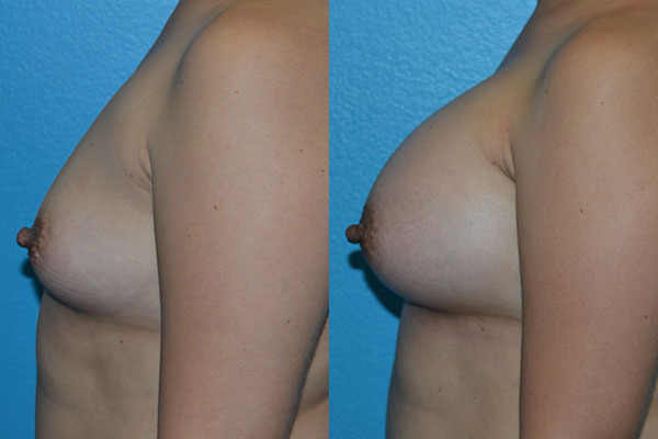 Augmentation