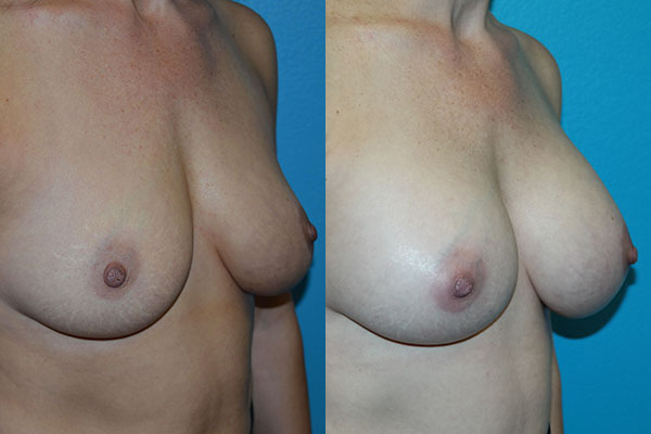 Augmentation