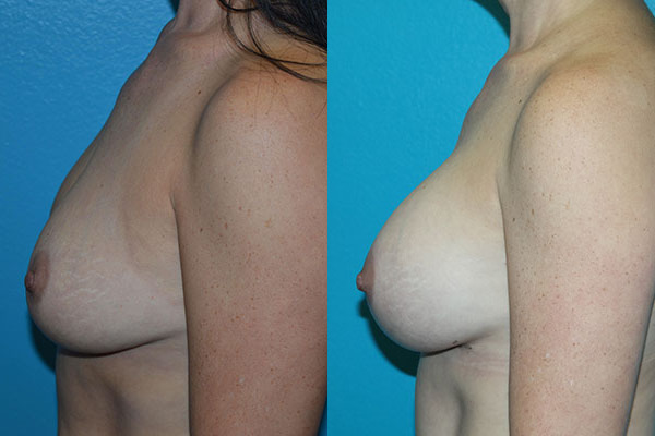 Augmentation