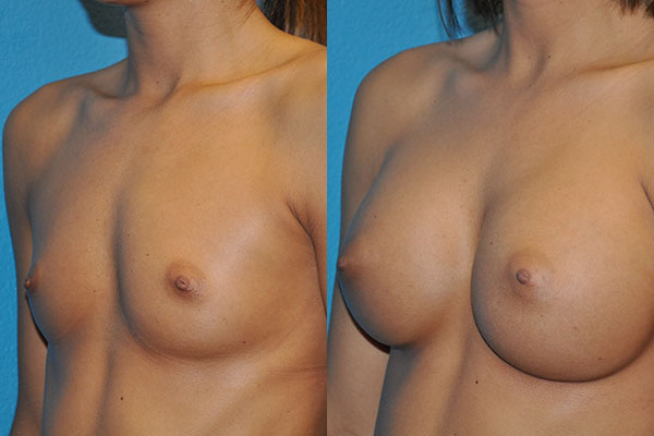 Augmentation
