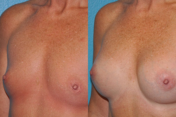 Augmentation