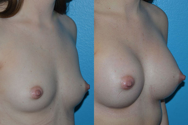 Augmentation