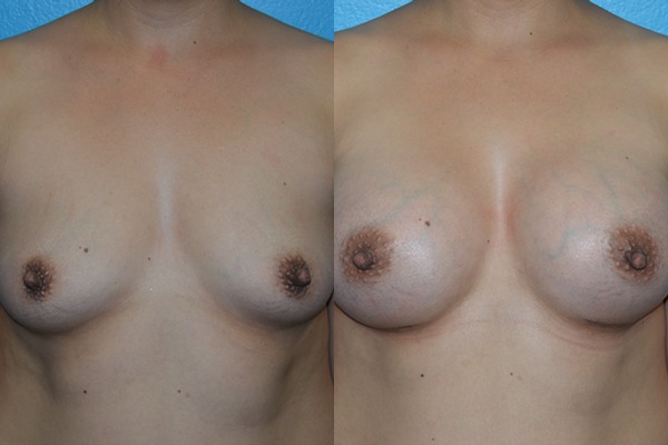 Augmentation