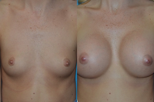Augmentation