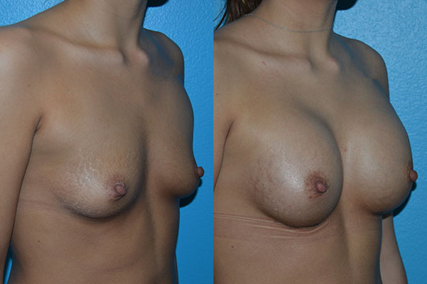 Augmentation
