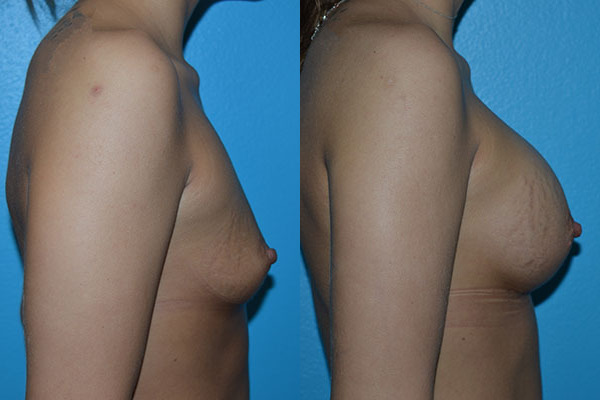 Augmentation