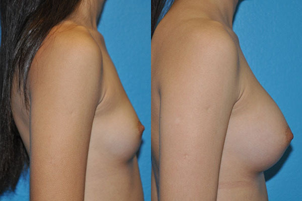 Augmentation