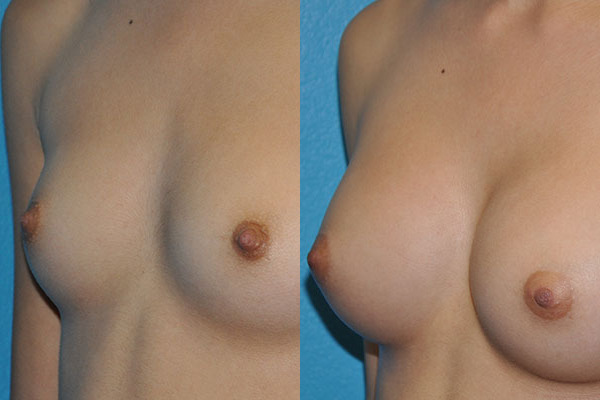 Augmentation