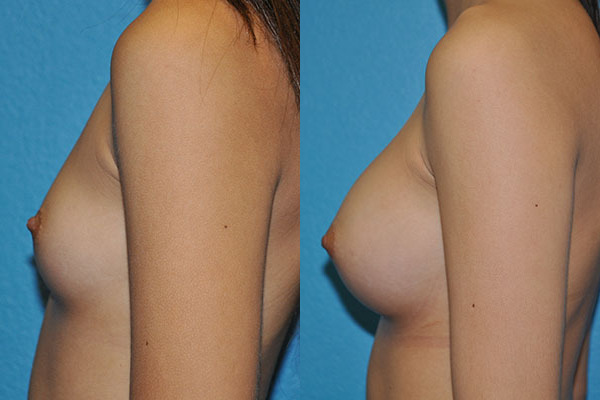 Augmentation
