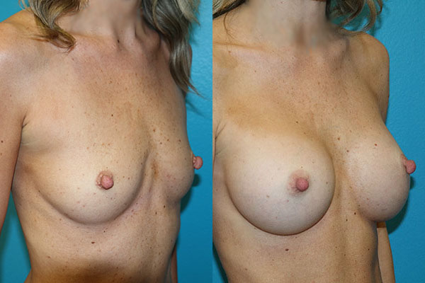 Augmentation