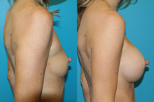 Augmentation