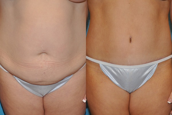 Abdominoplasty