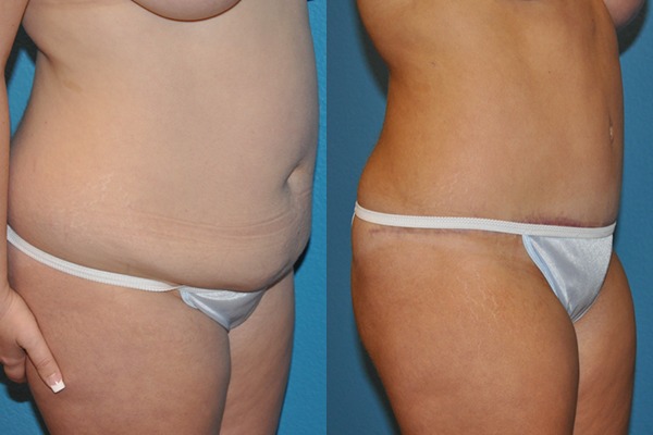Abdominoplasty