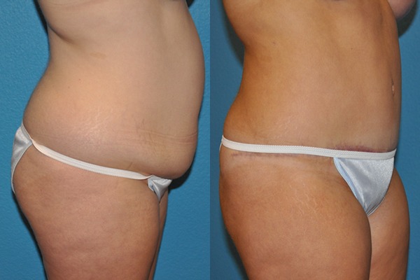 Abdominoplasty