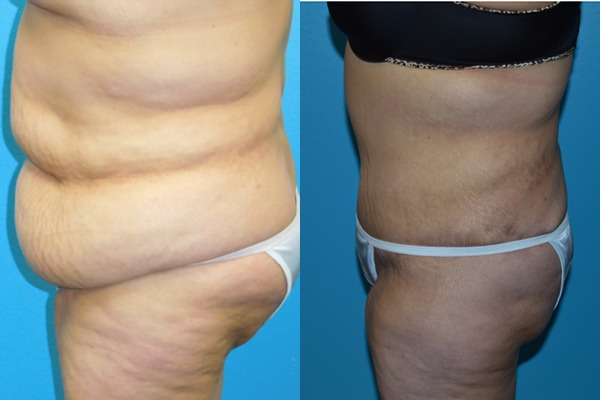 Abdominoplasty