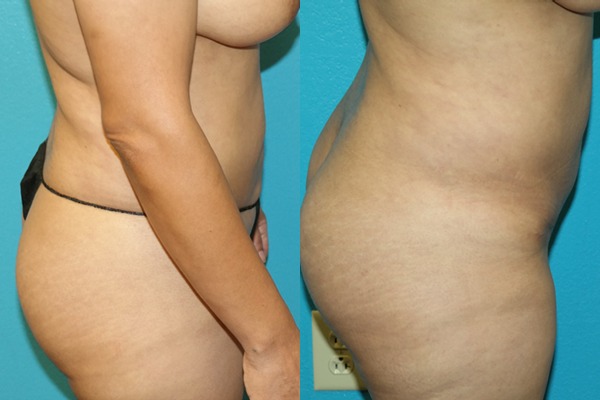 Abdominoplasty
