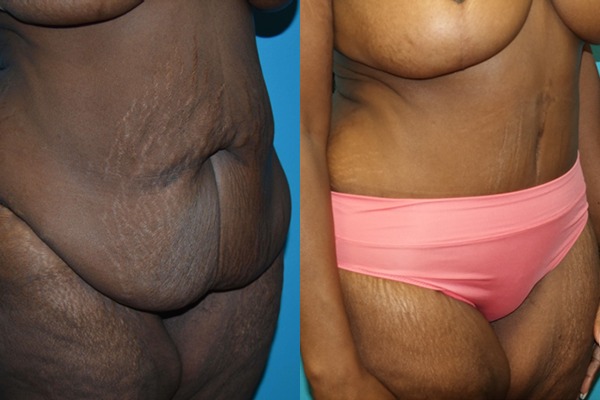 Abdominoplasty