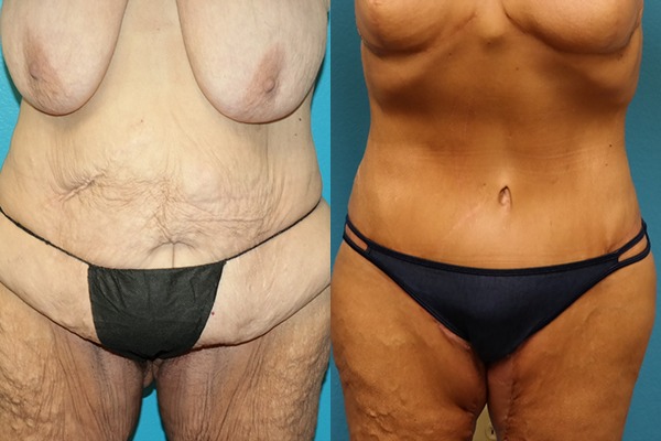Abdominoplasty