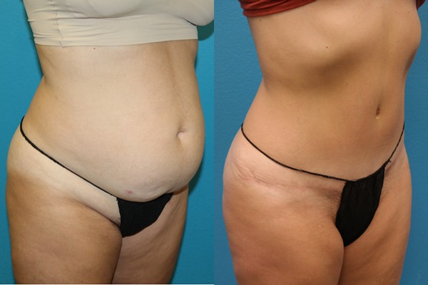 Abdominoplasty
