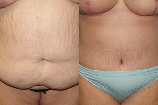 Abdominoplasty